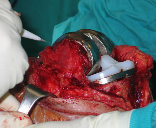 Knee Surgery Procedure