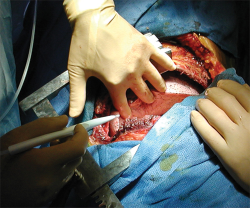 surgeon operating on open wound